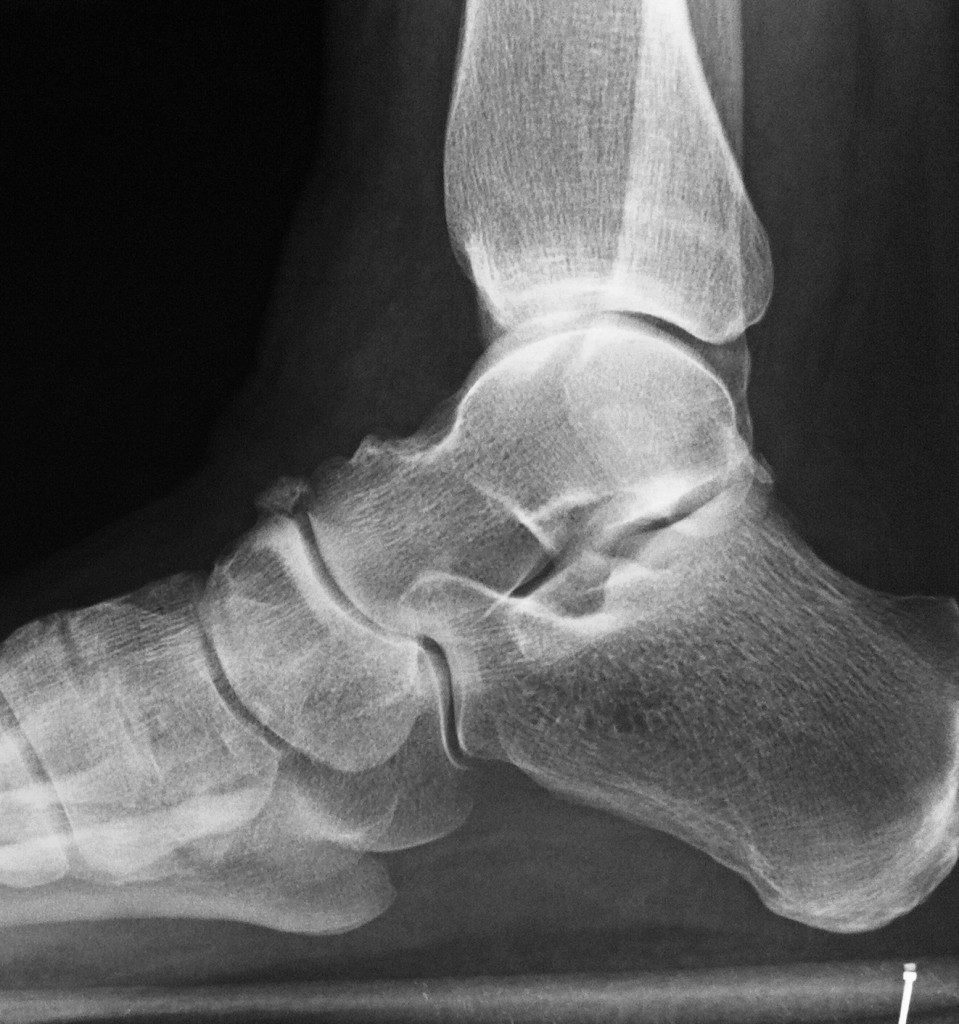 Heel-Pain-959x1024