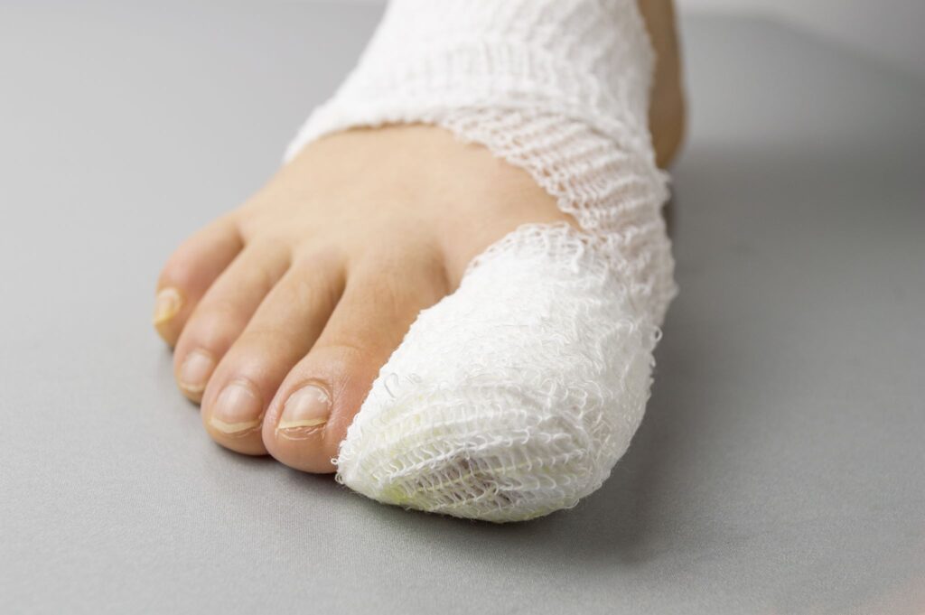 bandaged toe after ingrown toenail surgery