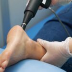Achilles tendon shockwave brisbane