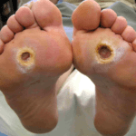 Bilateral, symmetical neuropathic foot ulcers affecting a person with diabetes. These are caused by loss of sensation and abnormal pressures under the forefoot.