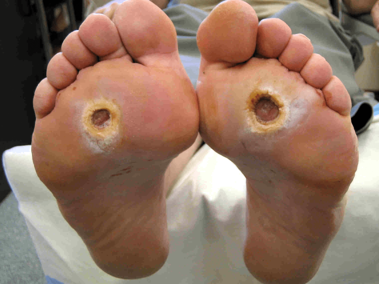 Bilateral and symmetical neuropathic foot ulcers, caused by loss of sensation and abnormal pressure under the forefoot