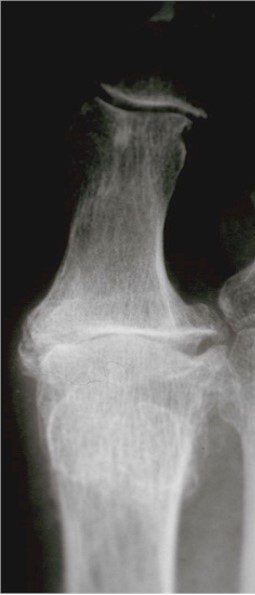 Severe osteoarthritis of the 1st MTP joint