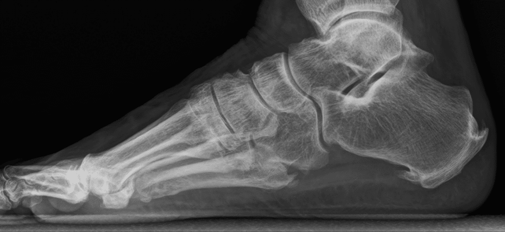 multiple heel spurs on x-ray of foot