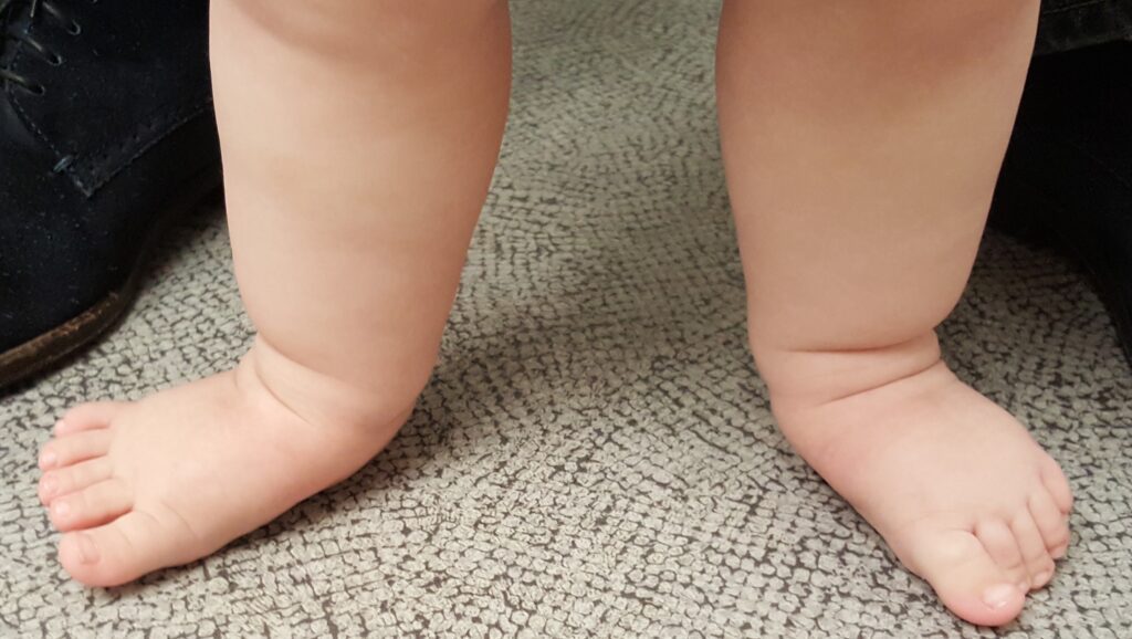 pronated feet in toddler podaitry