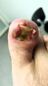 severe ingrown toenail podiatry practice