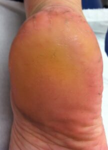cracked heels after treatment podiatrist brisbane