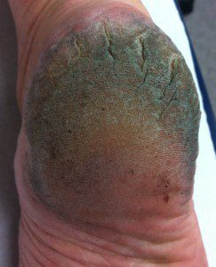 cracked heels podiatrist brisbane