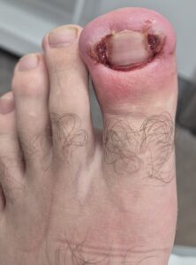 image of a painful ingrown toenail with mild infection before surgery