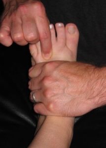 foot examination for a neuroma - Mulder's sign