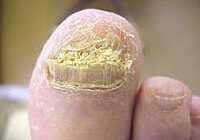 fungal nail infection